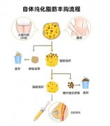 自体脂肪丰额头怎么样？效果好不好与费用多少