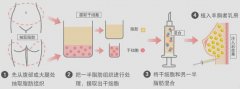 自体脂肪面部填充效果如何？维持时间与费用解析