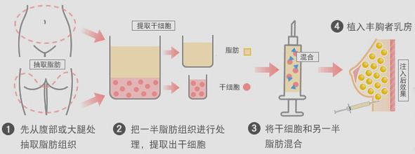 自体脂肪移植效果如何？费用详解及优势分析