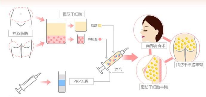 自体脂肪面部填充：效果如何？费用多少？