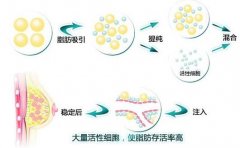 自体脂肪丰下巴效果如何？费用多少？