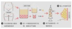 上海自体脂肪填充额头效果如何，费用几何，效果好不好