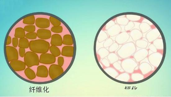 自体脂肪移植效果如何？费用详解及优势分析