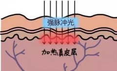 光子嫩肤和水光针哪个好