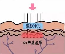 淘宝上的光子嫩肤仪有用吗