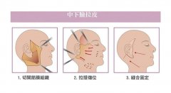 西宁美联臣整形医院电波拉皮的价钱是多少