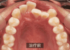 二次矫正牙齿的危害？建议好快速性完成牙齿矫正