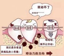 整牙牙齿矫正多少钱矫正佳年龄是多少？周期一般多久？