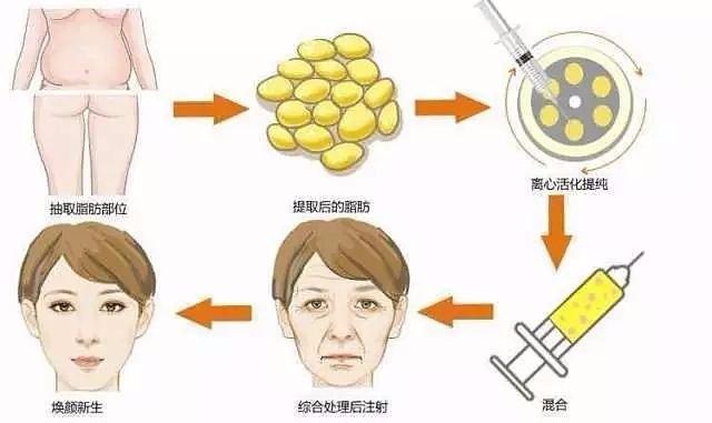 脂肪填充胸部价格多少左右？影响价格原因看这几个方面、科普篇