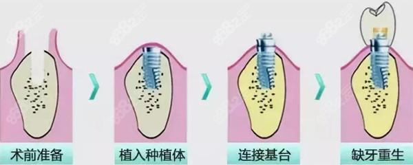 德国种植牙品牌排行及价格一览：费用多少，价格贵吗？了解德国、瑞士、韩国