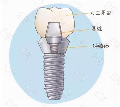 口腔种植牙医院推荐：排名前几的医院种植牙价格及影响因素解析