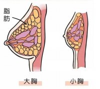 自体脂肪隆胸可以保持多少年？ 自体脂肪隆胸手术多少钱