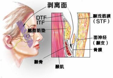 面部提升前后肌肤差别大吗？有哪些需要注意的事情