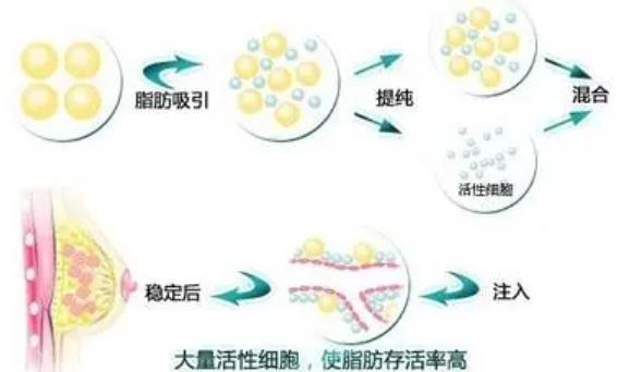 自体脂肪移脂丰胸成功率高吗？真实的效果如何