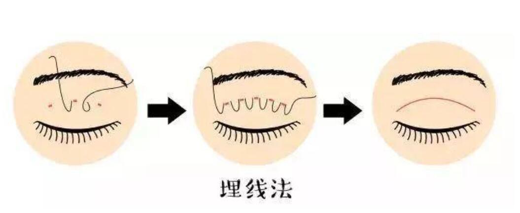 埋线双眼皮能维持几年？术后效果怎么样？