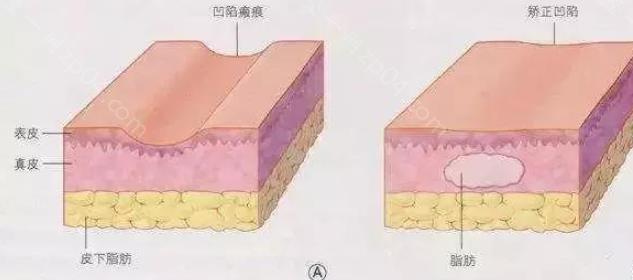 自体脂肪填充有害吗？北京八大处医院做填充的技术好不好