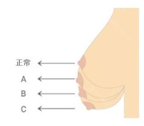 自体脂肪活细胞隆胸是怎么操作的？如何选择可靠的医院呢